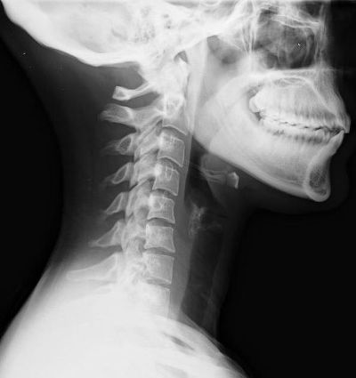 Whiplash - Loss of Cervical Curve | EP Wellness Clinic ® • 915-850-0900