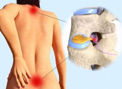 herniated disc chiropractic relief el paso tx.