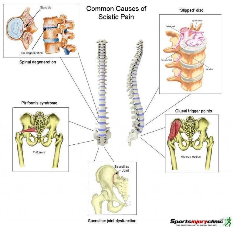 Nonsurgical Decompression Therapy For Piriformis Syndrome - El