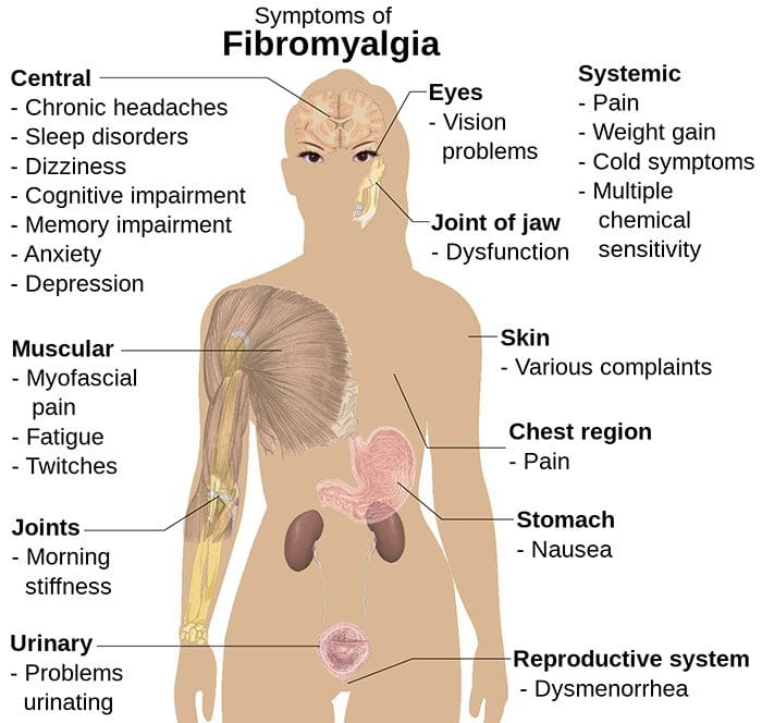 Fibromyalgia and Electric Shock Pain: Paresthesia