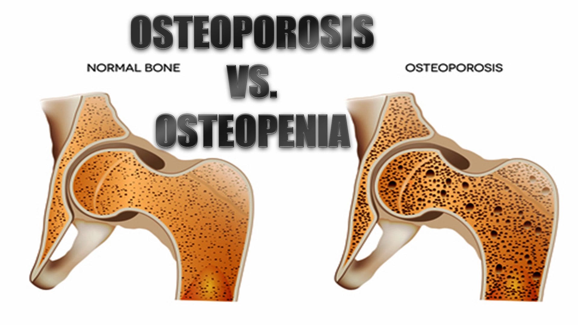 Osteoporosis Vs Osteopenia What s The Difference El Paso TX 