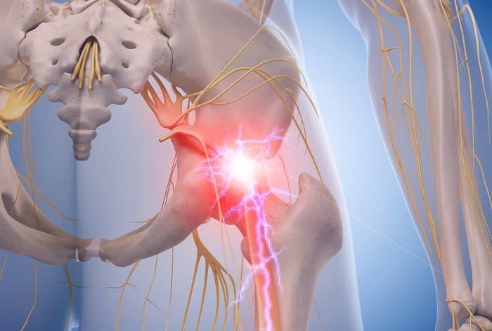 Diagnosis and Management of Piriformis Syndrome: An Osteopathic