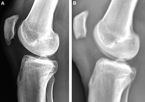 Qué hacer para el dolor de cuello al levantar pesos - Injured Call Today