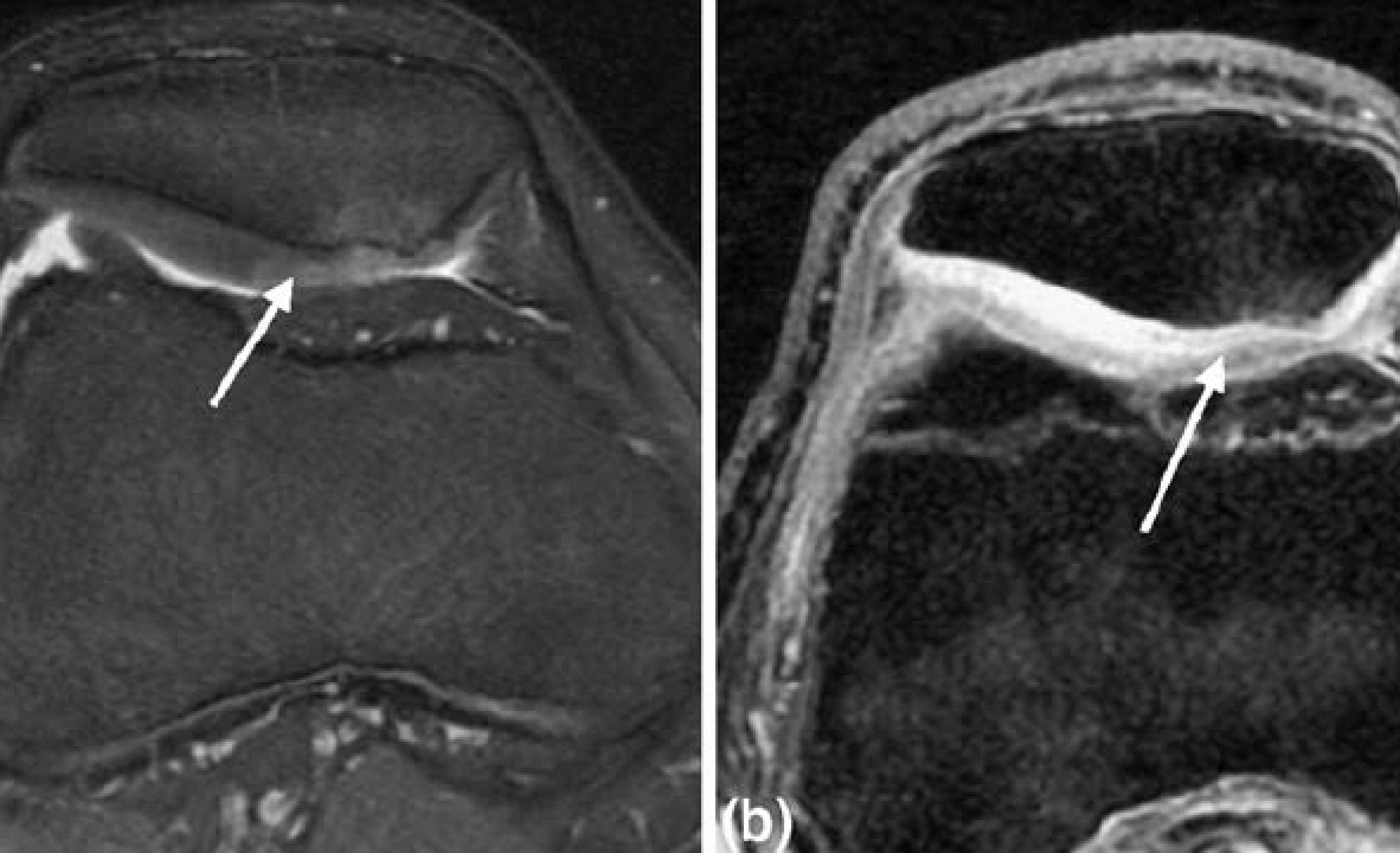 chondromalacia patella