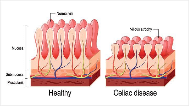 Celiaci-malattia-cause-e-fattori di rischio-alt-722x406