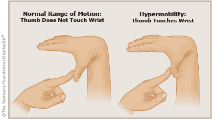 P-hypermobility-415x233-rd9-esIL