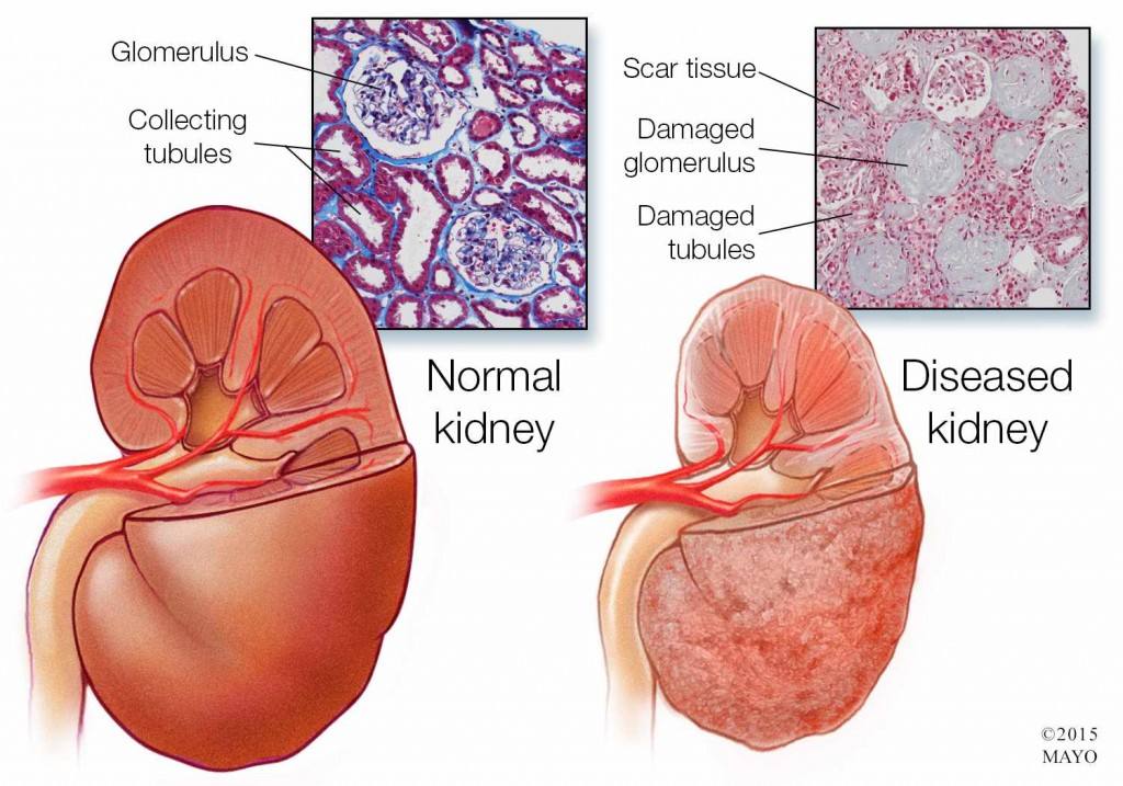 medical-illustration-of-healthy-and-diseased-kidneys