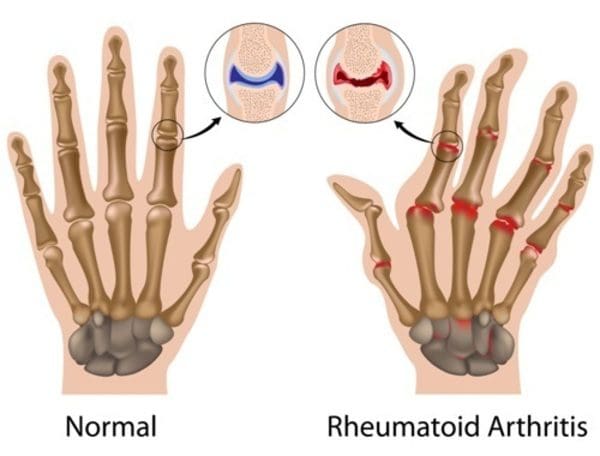 rheumatoid-arthritis-tangan