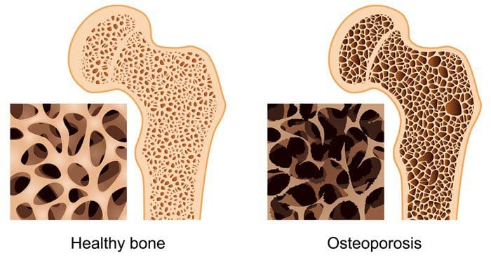 osteoporosis-naputol