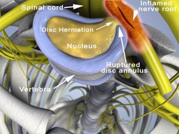 11860 Vista Del Sol, Ste. 128 Smoking Destroys The Spine and Can Cause Chronic Back Pain